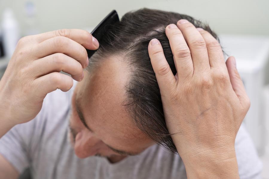 علت ریزش موی شدید در مردان