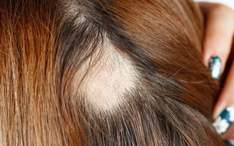 ریزش مو با الگوی زنانه (FPHL) یا آلوپسی