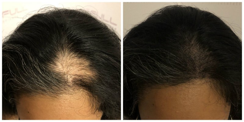 درمان ریز مو با میکروپیگمنتیشن در زنان
