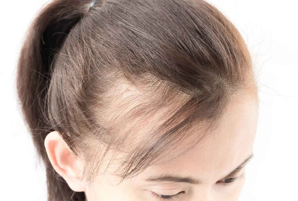 درمان ریزش مو با فی اسکالپ سر